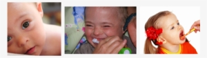 Periodontics And Down Syndrome - Toddler