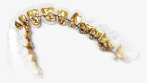 Lingual Braces Sydney - Incognito Braces