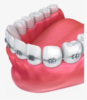 Png Transparent Braces