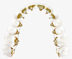 Lingual Braces - Incognito Lingual Braces Png