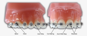 Images Braces Diagram - Philadelphia