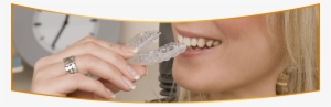 Clear Braces San Luis Obispo Ca - Clear Aligners