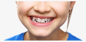 An Open Letter To Prospective Braces Users Everywhere - Phase I Orthodontic Treatment