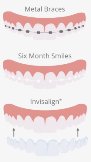 Teeth Straightening Illustration - Orthodontics