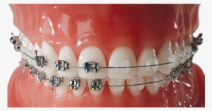 Brackets-blancoss - Brackets Invisibles