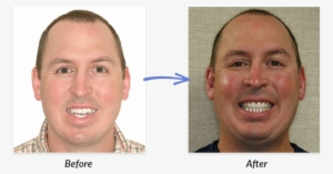 Before And After Braces Photo - Before Braces