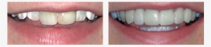 Before And After Teeth Whiting Treatment Case - Veneer