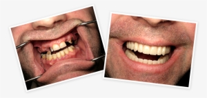 Find Out How To Replace Missing Teeth Without A Denture, - Tongue