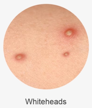 Comprises Blackheads Or Whiteheads Which Result From - Acne Transparent