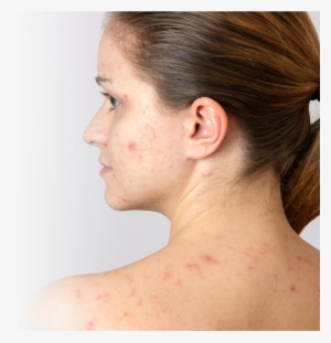 6 Solutions To Get Rid Of Adult Acne - Pregnancy Acne