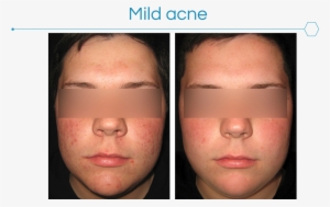 Acne Can Be Very Frustrating To The Patient And Have - Myers Dermatology