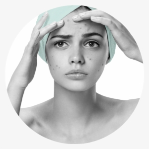 Noticia Anterior Acne Y Cicatrices Corporal Siguiente - Acne En Adolescentes