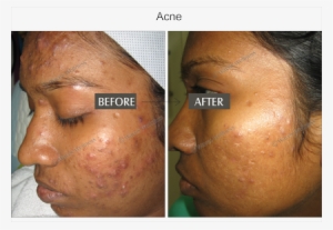 Acne