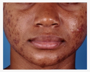 Zo® Oil Control Pads Acne Treatment Before - Zo Medical Before And After