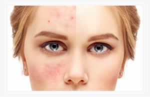 Acne Treatment - Gerötete Gesichtshaut