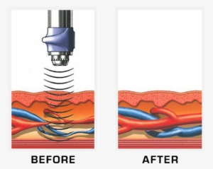 Peyronie's Disease Treatment