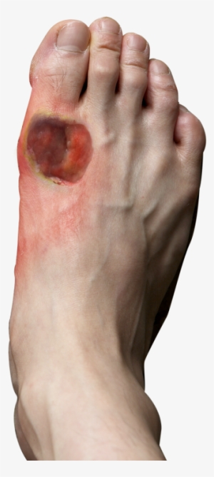 Signs And Symptoms Of Diabetic Foot - Diabetes Foot
