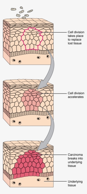 418 Development Of Cancer - Tissue Cell Diagram
