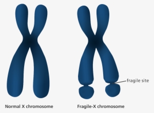 An Illustration Showing The Appearance Of Normal And - Fragile X Syndrome Diagram