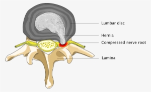Patient Suffering From Spinal Hernia - Spinal Hernia