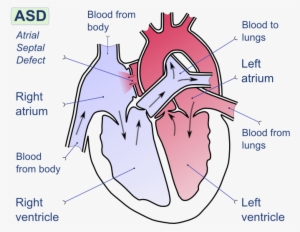 Hypoplastic Left Heart Syndrome - Atrial Septal Defect