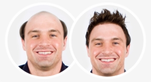 Hair Replacement System - Hair Toupee Before And After