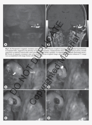 A) View Prior To Opening Subarcuate Cell Tract (arrow - Subarcuate Fossa