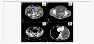 A Intravenous And Oral Contrast-enhanced Ct Scan Shows - Stomach
