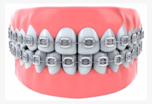 Teeth - Smoke Braces Color