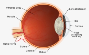Cataracts - Light Rays Pathway In The Eyeball Structure