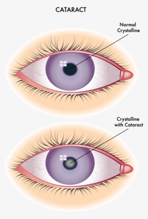 Cataracts Are A Clouding Of The Normally Clear Crystalline - Redness Of Conjunctiva
