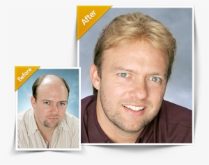 Hairpieces For Men Before And After