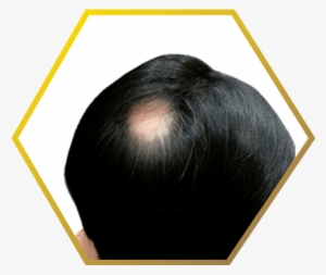Jonsson Protein Male Bald Spot - Jonsson Protein