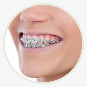 Color My Braces - Color Of Braces