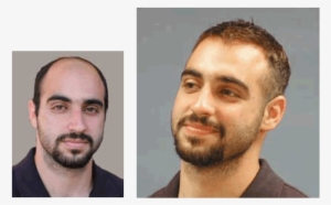 Men's Hair Replacement Systems Hair Piece Before And - Mens Hair