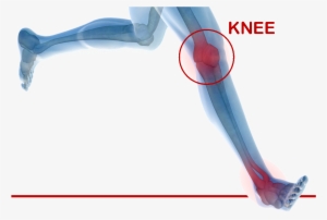 Kneeheader - Knee Replacement Png