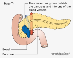 Predicting Pancreatic Cancer - Steve Jobs Murio De Cancer