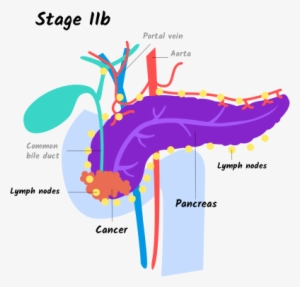 Illustration Of Stage Iib Pancreatic Cancer - Stage Iib Pancreatic Cancer