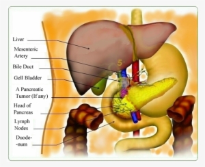 Location Of The Pancreatic Tumor - Pancreas In French