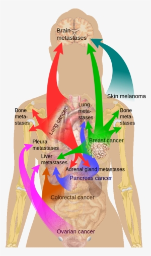Click Here Or - Cancer Metastasis