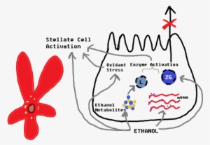 Hypothetical Development Of Alcoholic Pancreatitis - Alcohol And Pancreatitis