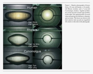 Shadow Photograph Of A 42year-old Lens Removed From - Human Lens Removed