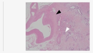 The Pathological Examination Revealed That The Tumor - Poster