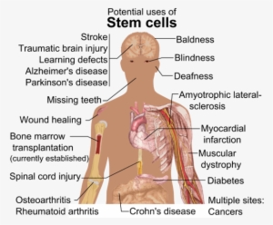 293 × 240 Píxeles - Can Stem Cells Cure