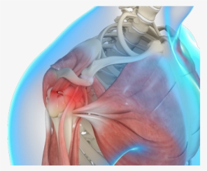 Rotator Cuff - Boise