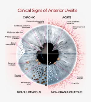 Optometry School, Anatomia Ocular, Globo Ocular, Autoimmune - Signs Of Anterior Uveitis