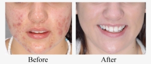 If You're Worried That Zit On Your Face Once You Wakened - Led Face Mask Before And After