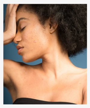 If You Suffer From Acne, You Know How Annoying It Is - Wrinkle