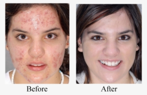 Acne Treatment - Neutrogena Led Mask Before And After
