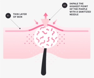 Death Of The Pimple - Pimple